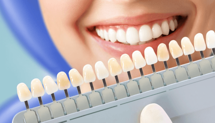 Teeth Whitening