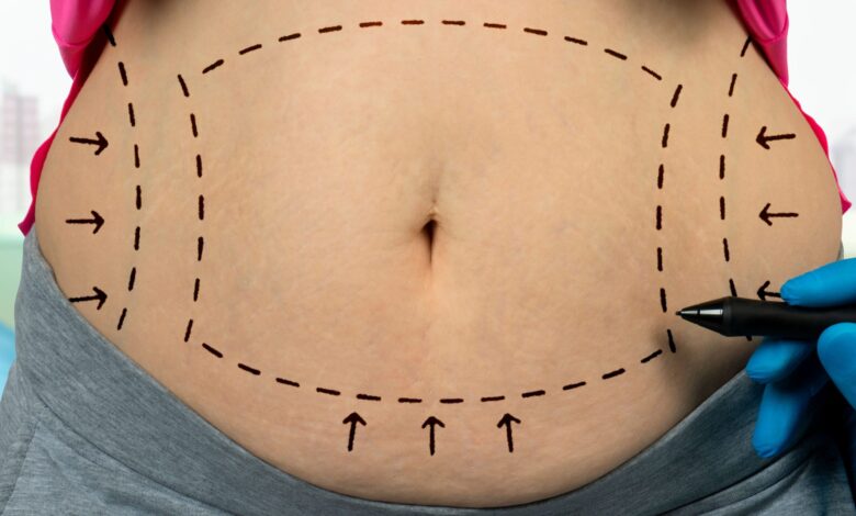 The Tummy Tuck Transformation